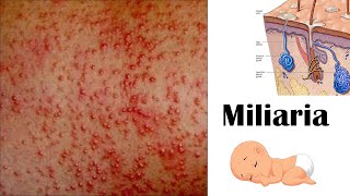 Miliaria Heat rash [upl. by Naujal480]