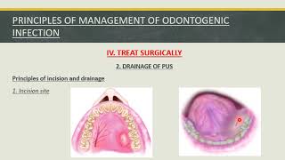 Fall 2020  Oral surgery 3  Lec 1  Orofacial infection [upl. by Hamon]