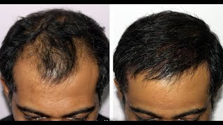 Hair growth with evion and zincovit 100 works Drsiddh zincovit evion [upl. by Balkin844]