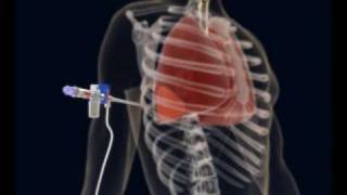 How to make a Thoracentesis pleural puncture with Pleurasafe [upl. by Lennie]