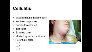 Spreading Orofacial Infections [upl. by Fritts387]