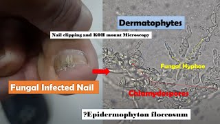 Fungal Infected Nail Microscopy showing Hyphae and Chlamydospores of Dermatophytes [upl. by Haimes]