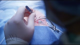 Strabismus Eye Surgery  Inside the OR [upl. by Orth]