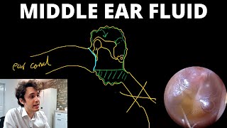 Why Does Fluid Build Up Behind The Eardrum Otitis Media With Effusion [upl. by Calvina232]