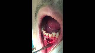 Dental Oral Surgery Apicoectomy Taibah University College of Dentistry [upl. by Kuebbing353]