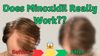 Can Minoxidil Regrow Your Hair Minoxidil Before and After [upl. by Picco957]