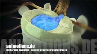 Herniation quotlumbarquot Treatment Surgery 3D Animation [upl. by Kurland253]