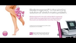 Biodermogenesi solution to stretch marks follow up after 5 years [upl. by Eyssej357]