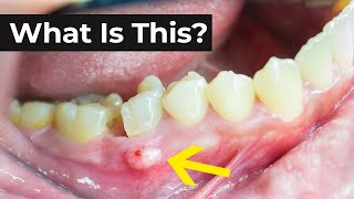 What is an Abscessed Tooth amp What To Do About It [upl. by Fidelis713]