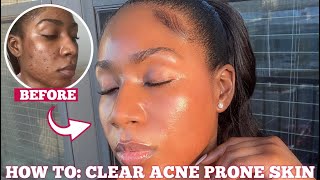 HOW I CLEARED MY ACNE SCARS amp HYPERPIGMENTATION FOR GOOD IN ONE MONTH  3 STEPS FOR FLAWLESS SKIN [upl. by Pax15]