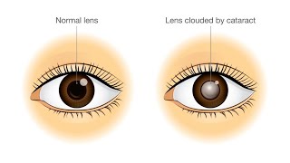 Causes amp symptoms of cataract ll मोतियाबिंद के कारण एवं लक्षण ll [upl. by Joleen788]