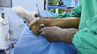 Peroneus longus tendon harvest for ACL Graft [upl. by Nosak]