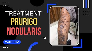 Prurigo Nodular Eczema Treatment ITCHY Skin bump एक्जिमा इलाज Dr Uttam Lenka [upl. by Solita]