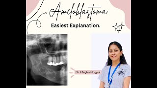 Ameloblastoma01  Easiest Explanation  Oral Pathology  BDS [upl. by Ches]