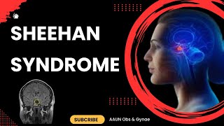 Sheehan Syndrome  Causes Symptoms Diagnosis Treatment and Pathophysiology [upl. by Luar]