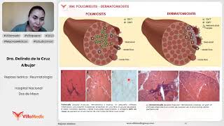 POLIOMIELITIS  DERMATOMIOSITIS  REUMATOLOGÍA  VILLAMEDIC [upl. by Clayborn]