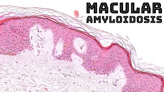 Macular amyloidosis cutaneous keratin derived amyloid pathology dermpath dermatology [upl. by Myrtia]