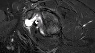 Superior subscapularis recess [upl. by Pournaras]