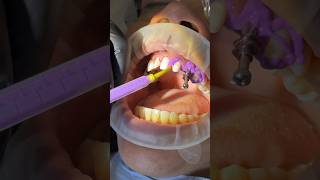 Open Tray Impression with Panasil XLight and Tray Soft Heavy kettenbachusa dentist impression [upl. by Yennaiv656]