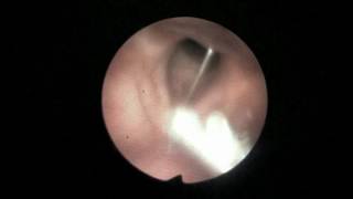 Paper Pin Foreign Body OVER Vocal Cord [upl. by Torrence]