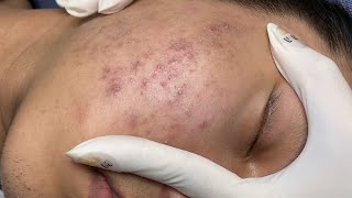 ACNE TREATMENT VU QUYNH MI Acne On Boys Chin 2024 [upl. by Aiello]