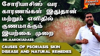 சோரியாசிஸ் பிரச்சனைக்கு நிரந்தர தீர்வு  Psoriasis Natural Treatment Tamil  Skin Disease Treatment [upl. by Ruby880]