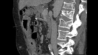 Cystic Fibrosis Gastrointestinal and Skeletal Findings [upl. by O'Connell219]