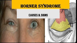 UNDERSTANDING HORNER SYNDROME  CAUSES amp SIGNS [upl. by Anneyehc]