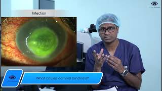 What causes corneal blindness [upl. by Jaret]