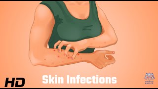 Skin Infections Uncovered What Your Dermatologist Wants You to Know [upl. by Nnyleitak]