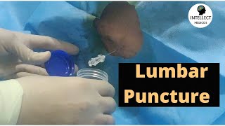 Lumbar Puncture Procedure in just 11 mins [upl. by Koy]