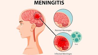 Meninges  Meningitis symptoms Diagnosis And Treatments [upl. by Merideth]