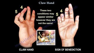 Claw Hand Ulnar Claw Hand  Everything You Need To Know  Dr Nabil Ebraheim [upl. by Tanhya765]