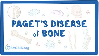 Paget disease of bone [upl. by Nahij]