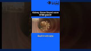 ESWL  Lithotripsy  Kidney Stone Treatment  Retrograde Intrarenal Surgery  shorts [upl. by Nnyw353]