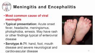 5 Enterovirus clinical manifestations including poliore [upl. by Kingsly311]