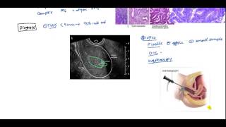 Endometrial Cancer and Hyperplasia for USMLE [upl. by Ruella]