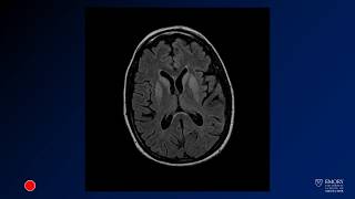 Neuroradiology board review lecture 1 case 4 [upl. by Annaerb]