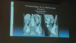 HIPERPLASIA PROSTÁTICA BENIGNA GENERALIDADES DIAGNOSTICO Y TRATAMIENTO [upl. by Sisi116]