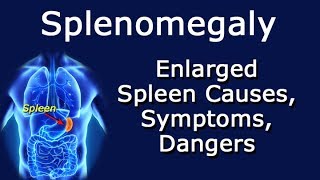 Splenomegaly Enlarged Spleen Causes Symptoms Dangers [upl. by Nahtanoy]