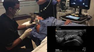 Ultrasound guided aspiration and lavage of calcific tendinitis [upl. by Oicul892]