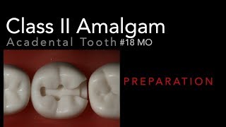 Class II Amalgam Preparation  18 MO Acadental Typodont [upl. by Zebe]