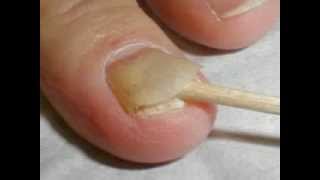 Nail psoriasis symptoms [upl. by Suoiradal]