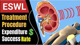 Extracorporeal Shock Wave Lithotripsy In Hindi  Lithotripsy Treatment For Kidney Stone In Hindi [upl. by Hodgkinson726]