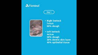 Case report  Treatment of a category 3 pressure ulcer over the lower sacral area with Flaminal® [upl. by Ayoral]