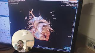 CT pulmonary Angiography Procedure Detailed Explanation part2 avnishradiology [upl. by Anrat]