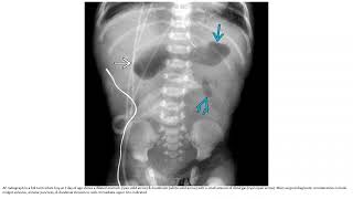 Duodenal Atresia or Stenosis Imaging [upl. by Nnylyt]