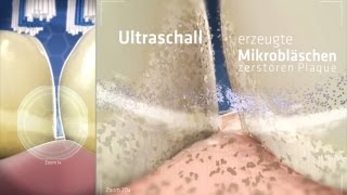 So funktioniert die Zahnreinigung mit echtem Ultraschall  emmident [upl. by Ahsaenat362]