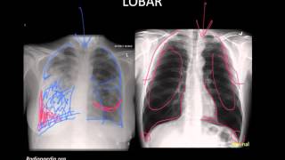 Pneumonia Imaging [upl. by Latin67]