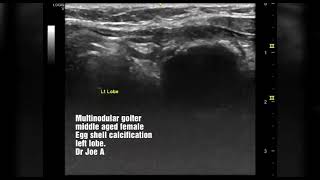 Multinodular goiter thyroid  eggshell calcification ultrasound video [upl. by Mcgraw939]